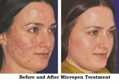 AcneBeforeandAfterwithEclipseMicropenMicroneedelingatMediSpaandSaloninCollegeStationTX778452_srcset-large
