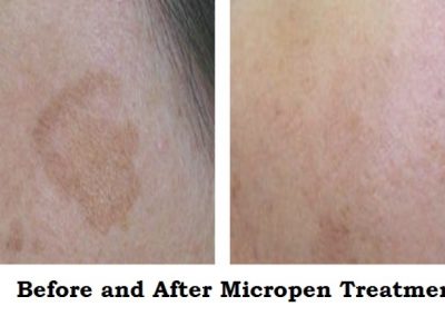 MelasmaBeforeandAfterwithEclipseMicropenMicroneedelingatMediSpaandSaloninCollegeStationTX778452_srcset-large