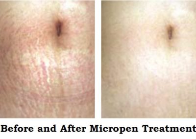 StrechMarksBeforeandAfterwithEclipseMicropenMicroneedelingatMediSpaandSaloninCollegeStationTX778452_srcset-large